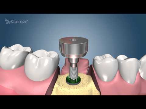 Dental Implant Procedure - Two Stage
