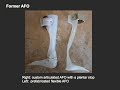 A simple \"energy storage & return\" Orthosis - part 1 A simple \"energy storage & return\" Orthosis - part 1