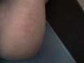 CELULITIS MIEMBRO INFERIOR- Cellulitis in Low Right Member