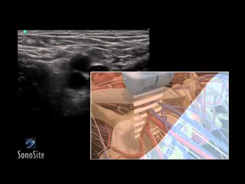 how to locate femoral vein