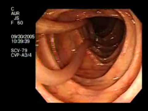how to cure human worms