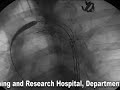 Endovascular Surgery Endovascular Surgery