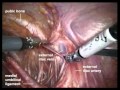 Prostate Cancer - Extended Pelvic Nodes Resection In A Robot-Assisted Laparoscopy Prostate Cancer - Extended Pelvic Nodes Resection In A Robot-Assisted Laparoscopy