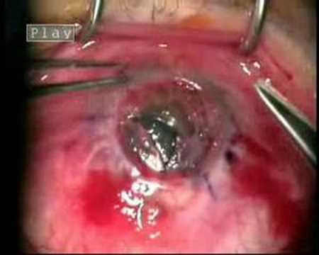 formaldehyde burn after pynguecula ...
