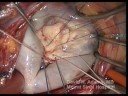 Mitral Valve Repair of Fibroelastic Deficiency Mitral Valve Repair of Fibroelastic Deficiency