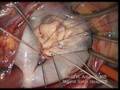 Mitral Valve Repair of Fibroelastic Deficiency