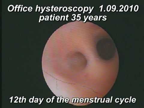 how to care after miscarriage