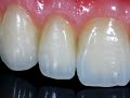 Protocólo Cerâmico e Enceramento Estético Anterior Protocólo Cerâmico e Enceramento Estético Anterior
