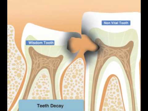 how to relieve growing wisdom teeth pain