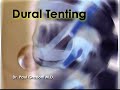 Epiduroscopy - interpretation: dural tenting Epiduroscopy