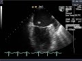 Ruptured Papillary Muscle on Echocardiogram