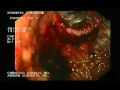 Esophyx - Endoscopic Fundoplication, Part 3.