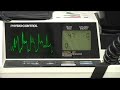 Coarse V-Fib