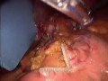 LapBand Removal Converted to Mini-Gastric Bypass