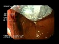 Esophyx - Endoscopic Fundoplication, Part 2.