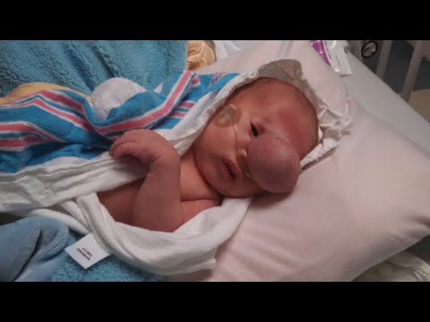 Lekarze usunęli wielką narośl z twarzy maluszka. Widok jego buzi po zabiegu wzruszył wszystkich