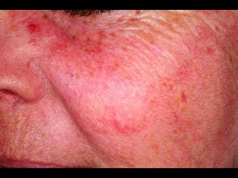 how to relieve redness