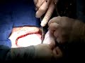 Live Webcast: Hernia Complex Repair Using Veritas Collagen Collagen Replacement