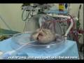 EX VIVO LUNG: Transplant surgeons at Toronto General Hospital make medical history