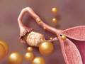 Ovaries and Dementia-Mayo Clinic