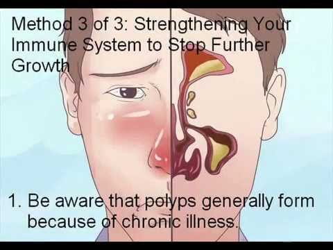 how to treat nasal polyps