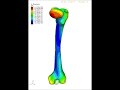 Modal Analysis of Femur by Finite Element Method