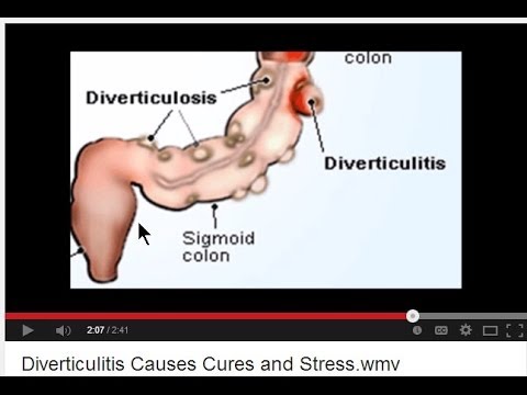 how to cure diverticulitis