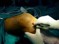 septic arthritis knee arthroscopy ผ่าตัดส่องกล้อง ข้อเข่า