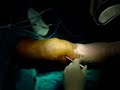 septic arthritis knee arthroscopy ??????????????? ???????