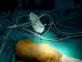 septic arthritis knee arthroscopy ผ่าตัดส่องกล้อง ข้อเข่า