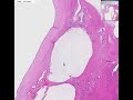 Histopathology Soft tissue, dorsal wrist--Ganglion Histopathology Soft tissue, dorsal wrist--Ganglion