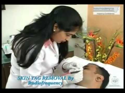 how to remove a tick nhs