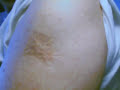Old style smallpox vaccination scar