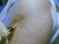 Old style smallpox vaccination scar