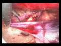 videos de laparoscopic hernia repair