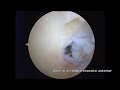Artroscopia de Codo. Condromatosis. Dr. Galindo Artroscopia de Codo. Condromatosis. Dr. Galindo