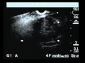 Cancer Of The Rectum In EUS, T3N0 Stage Cancer Of The Rectum In EUS, T3N0 Stage