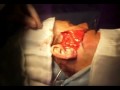 Cosmetic Surgery in  India - Dr.Surindher - Face lift ( MACS lift)