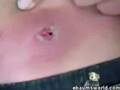 This is pretty sick....tapeworm in stomak