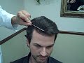 Dr Epstein patient-3059 grafts dense packed 5 1/2 months Dr Epstein patient-3059 grafts dense packed 5 1/2 months