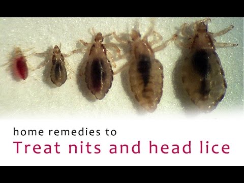 how to treat lice eggs