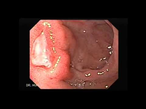 how to treat nsaid induced ulcers