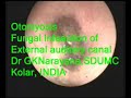otomycosis fungal infection of ear