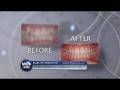 videos de Invisalign Specialist
