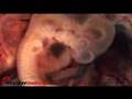 YouTube - Insidermedicine in 60 - February 6, 2008