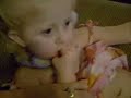 Mic-Key Buttons 101  Birth Defects Cleft Palate
