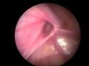 Laparoscopic Herniotomy 2