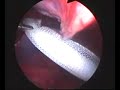 Laparoscopic Hernia Repair Laparoscopic Hernia Repair