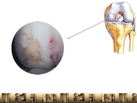 how to rebuild knee cartilage