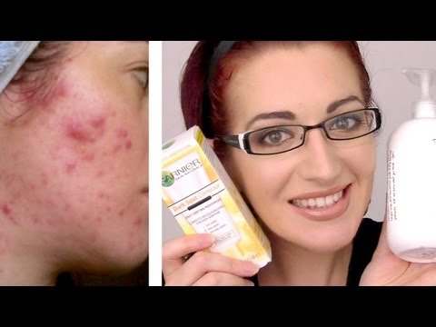 UPDATED! 2013 BEST ACNE SKIN CARE ROUTINE! Morning & Night (Acne.Org, Garnier, Exposed)
